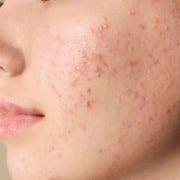 ACNE CONTROL